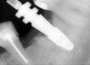 straumann имплант