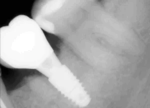 импланты штрауман